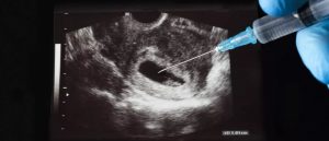 Lee más sobre el artículo Un médico desmonta a los abortistas: «Aunque no escuchamos al feto decir ‘me duele’, su cuerpo sí responde»